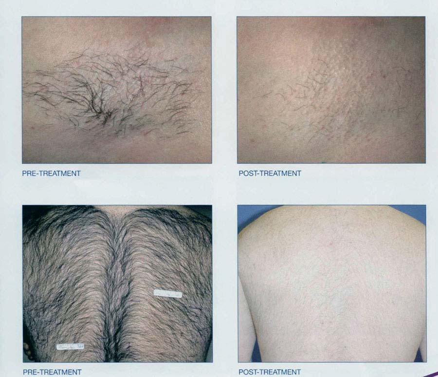 Laser Hair Removal | New Radiance Cosmetic Center of Palm ...