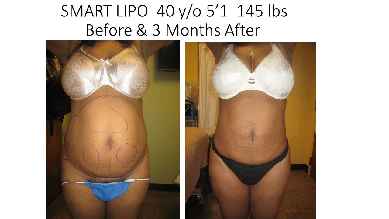 Liposuction Fat Transfer 111