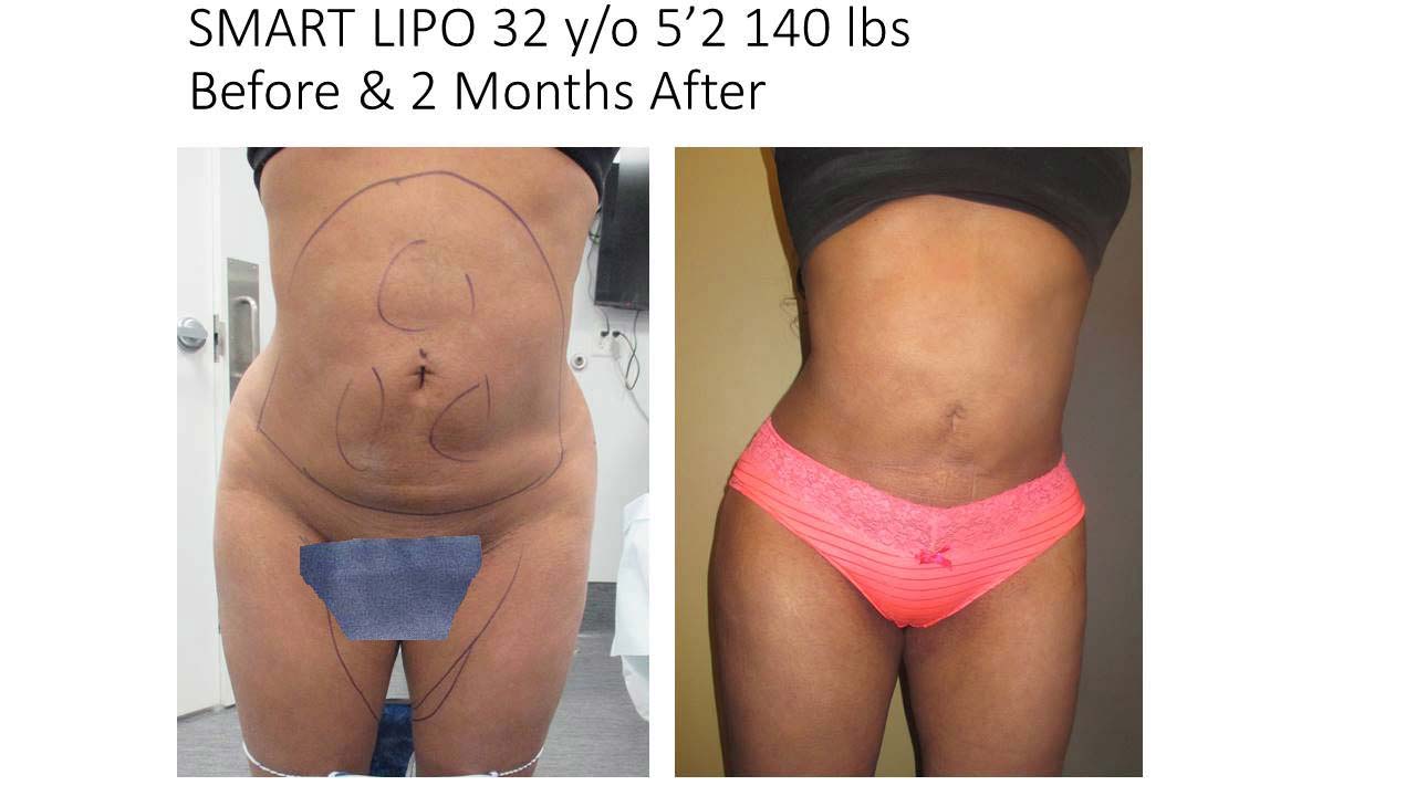 Liposuction Fat Transfer 11
